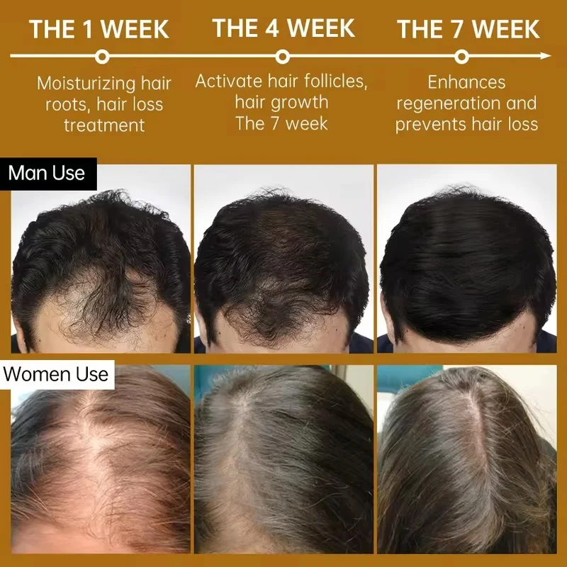 Hair Growth Products Anti Hair Loss Essential Oil Prevent Baldness Scalp Treatment Capsule Fast Regrowth Beauty Health Men Women - Image 2